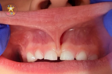 Lip And Tongue Tie Release
