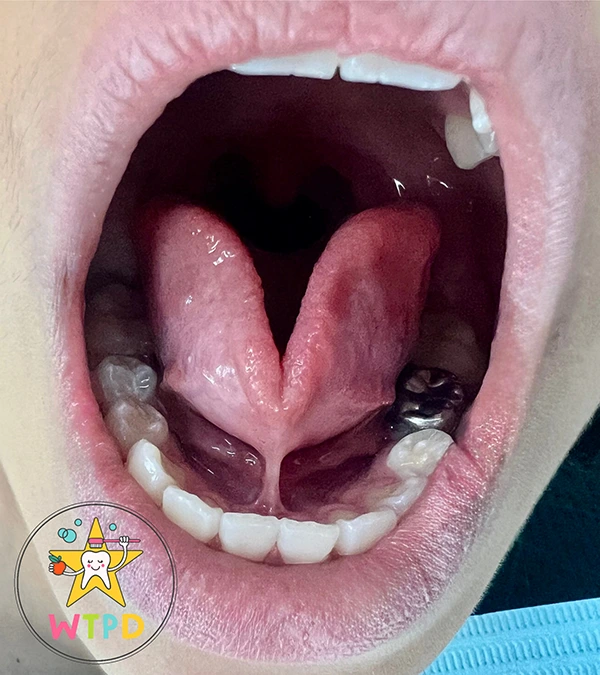 Person With Tongue Tie